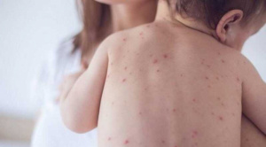 Pando reporta primer caso de Sarampión y declara alerta sanitaria roja 1